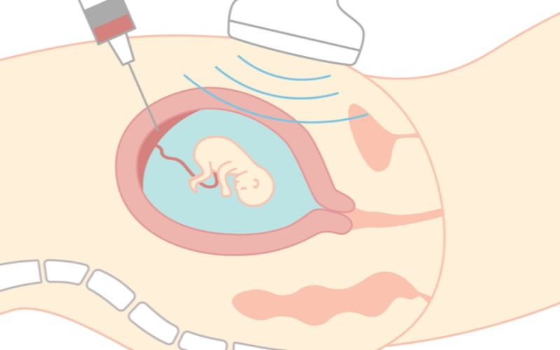 Xét nghiệm ADN từ mẫu nước ối hoặc sinh thiết gai nhau cung cấp kết quả chính xác. 