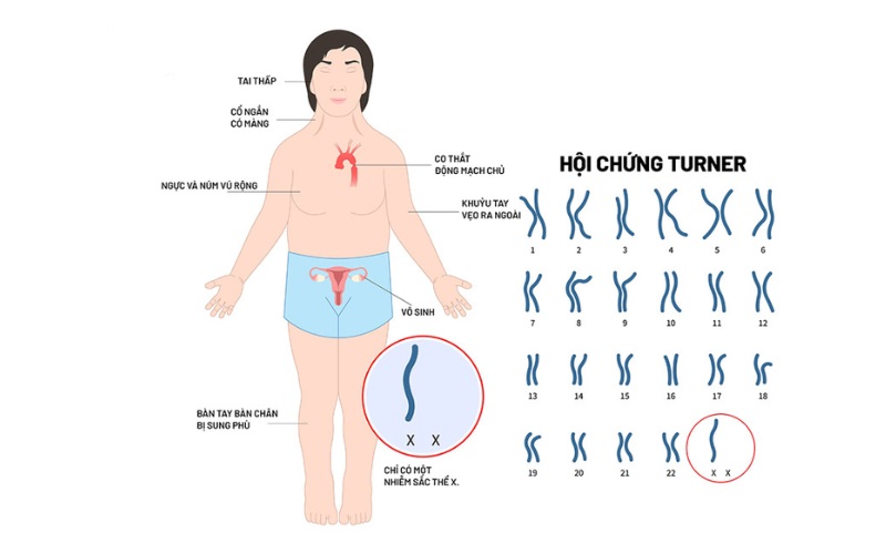 Hội chứng Turner là một rối loạn di truyền liên quan đến nhiễm sắc thể giới tính ở nữ giới. 