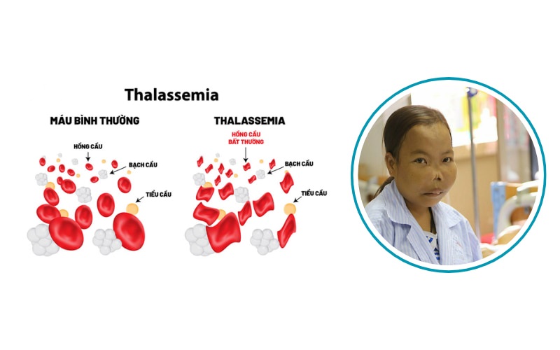 Bệnh Thalassemia xảy ra do đột biến gen, gây ảnh hưởng đến quá trình tổng hợp hemoglobin. 