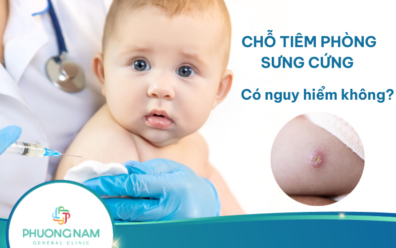 Vết tiêm phòng bị sưng cứng ở trẻ em có sao không? Cách xử trí