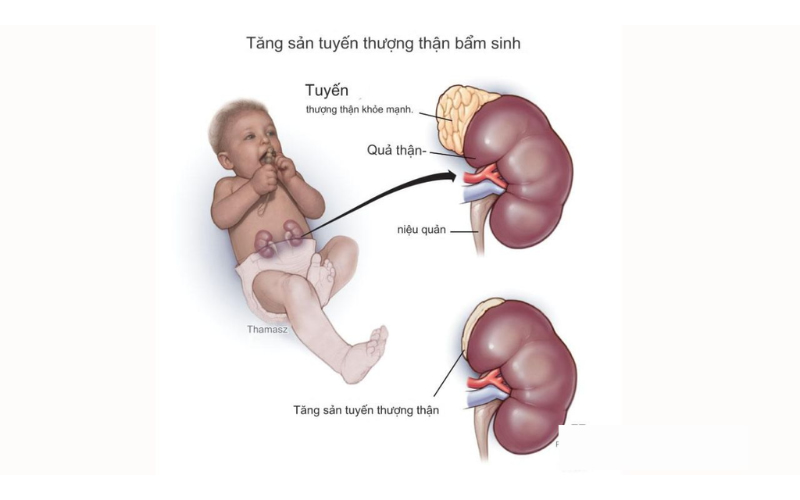 Tăng sản thượng thận bẩm sinh (CAH) là một bệnh di truyền gây ra bởi sự rối loạn trong quá trình tổng hợp hormone của vỏ thượng thận. Bệnh này có thể ảnh hưởng đến sự phát triển của cơ quan sinh dục và quá trình dậy thì của trẻ.