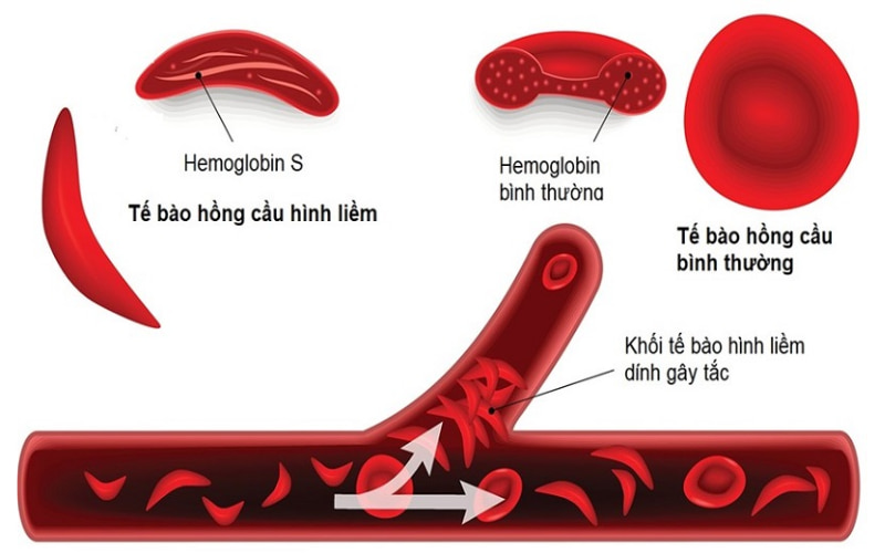 Bệnh hồng cầu hình liềm là một rối loạn máu di truyền nghiêm trọng.