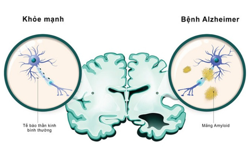 Bệnh Alzheimer có thể di truyền qua các thế hệ, nếu người mắc bệnh có 1 trong 2 loại gen: gen xác định và gen nguy cơ