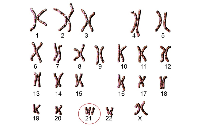Hội chứng Down là một tình trạng di truyền xảy ra khi một người có thêm một bản sao hoàn toàn hoặc một phần của nhiễm sắc thể số 21.