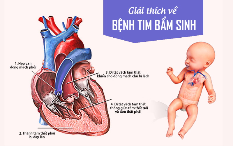 Bệnh tim bẩm sinh là tình trạng tim và mạch máu không phát triển bình thường ngay từ khi còn trong bụng mẹ. 