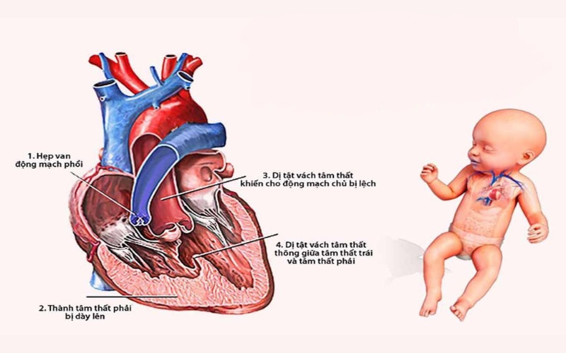 Theo ước tính, khoảng 40 – 60% người mắc bệnh động mạch vành (CAD) có liên quan đến yếu tố di truyền.