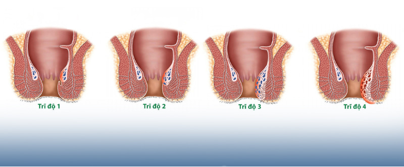 Bệnh trĩ được chia thành các loại khác nhau dựa trên vị trí và mức độ nghiêm trọng của các búi trĩ. 