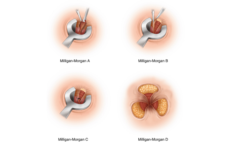 Phương pháp phẫu thuật cắt trĩ Milligan Morgan