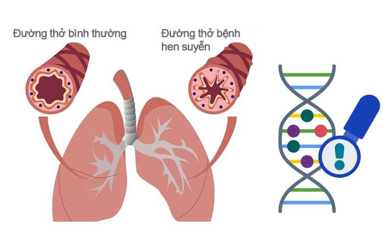 Cả yếu tố di truyền và môi trường đều góp phần gây ra bệnh hen suyễn