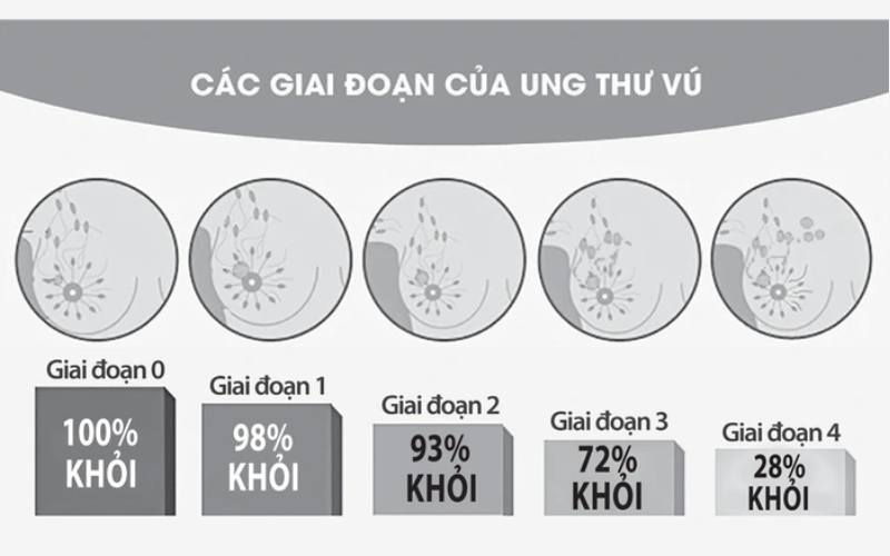 Giai đoạn ung thư vú là yếu tố tiên lượng quan trọng, quyết định phác đồ điều trị và khả năng phục hồi của bệnh nhân.