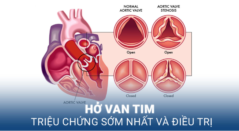 Các nghiên cứu khoa học đã chứng minh rằng, bệnh hở van tim không có yếu tố di truyền. 