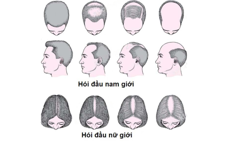 Tình trạng rụng tóc do nội tiết tố androgen (Androgenetic alopecia), tên gọi y khoa của MPB và FPB, là nguyên nhân phổ biến nhất gây ra tình trạng hói đầu.