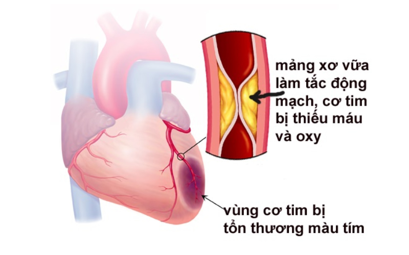 Tỷ lệ nhồi máu cơ tim ngày càng tăng ở nước Việt Nam