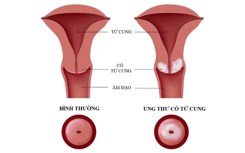 Ung thư cổ tử cung không phải là bệnh di truyền.