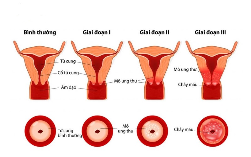 Các giai đoạn ung thư cổ tử cung 