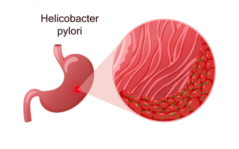 Yếu tố nguy cơ chính liên quan trực tiếp đến ung thư dạ dày là vi khuẩn Helicobacter pylori và thói quen ăn uống.