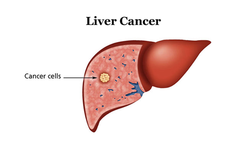 Ung thư gan là một trong những bệnh ung thư phổ biến nhất tại Việt Nam, đứng thứ tư trong số các loại ung thư hay gặp