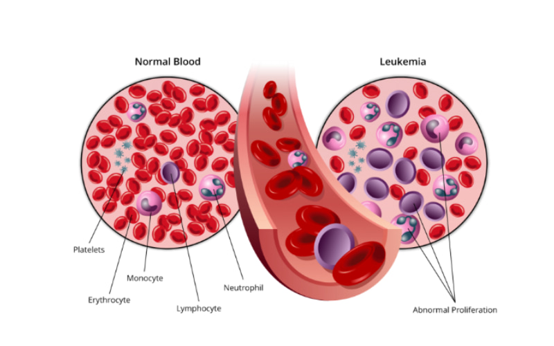 Hình minh họa tế bào máu bình thường (bên trái) và tế bào máu của người bệnh ung thư máu (bên phải).
