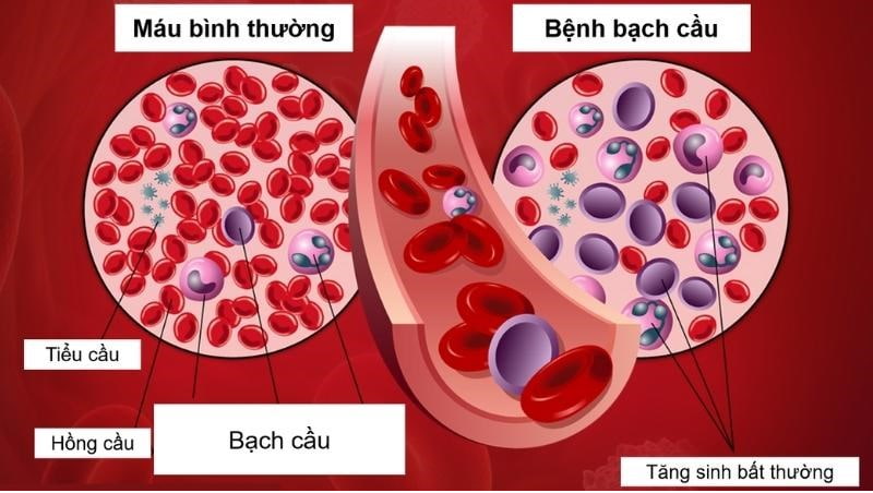 Bệnh bạch cầu được đặc trưng bởi sự gia tăng bất thường của các tế bào bạch cầu ác tính.