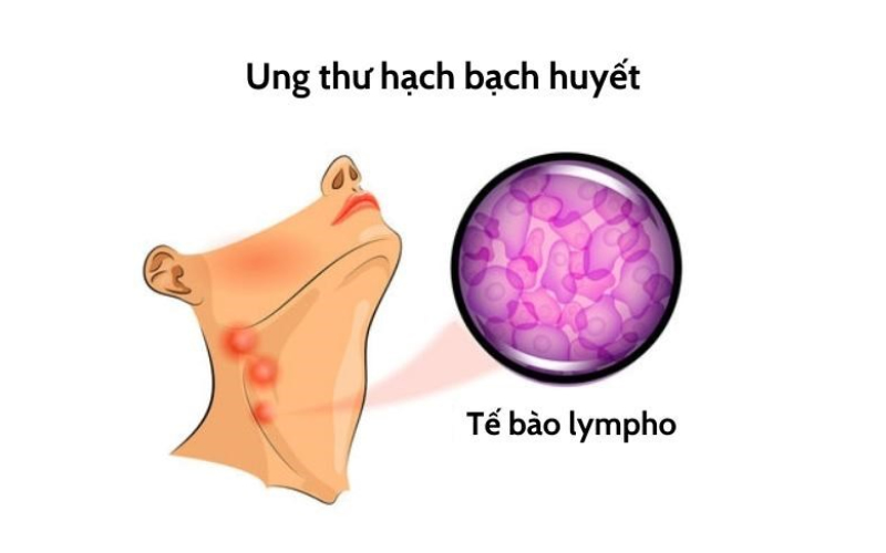 Lymphoma là một loại ung thư phát triển từ các tế bào bạch huyết.