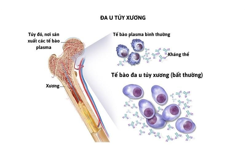 U tủy gây tổn thương cấu trúc và suy giảm chức năng của tủy xương.