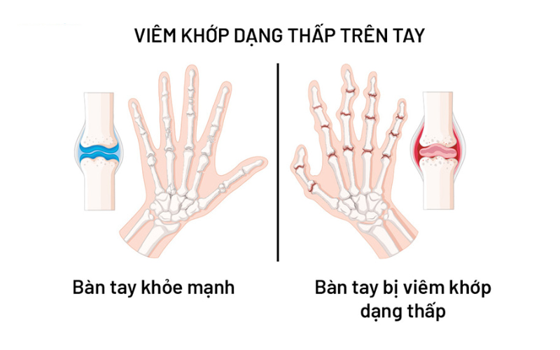 Nếu không được điều trị sớm hoặc điều trị không hiệu quả, viêm khớp dạng thấp có thể gây tổn thương và phá hủy khớp nghiêm trọng, không thể hồi phục.