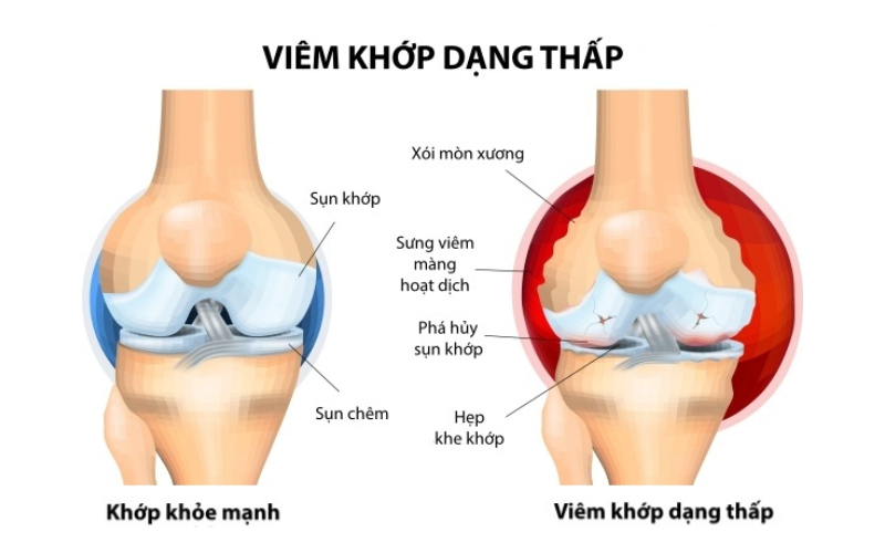 Hiện tại, chưa có phương pháp nào chữa khỏi hoàn toàn bệnh viêm khớp dạng thấp 