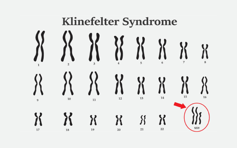 Hội chứng Klinefelter là một rối loạn di truyền xảy ra khi một bé trai sinh ra có thêm một nhiễm sắc thể X trong bộ nhiễm sắc thể của mình.