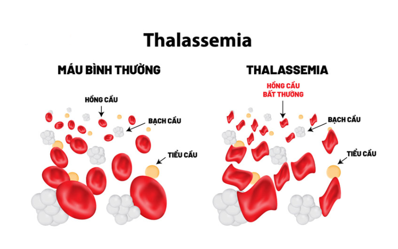 Khi mắc bệnh thalassemia, cơ thể sản xuất hemoglobin không đủ hoặc có cấu trúc bất thường, dẫn đến thiếu máu và các vấn đề sức khỏe khác.