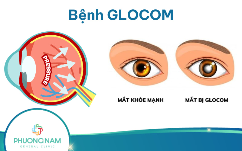 Bệnh Glocom: Nguyên nhân, triệu chứng và cách điều trị