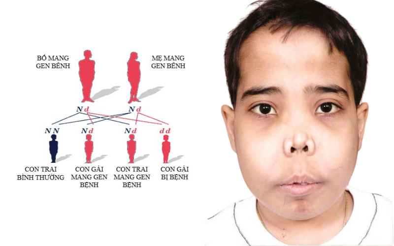 Thalassemia là bệnh di truyền lặn trên nhiễm sắc thể thường