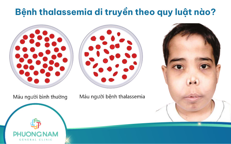 Bệnh thalassemia di truyền theo quy luật nào?