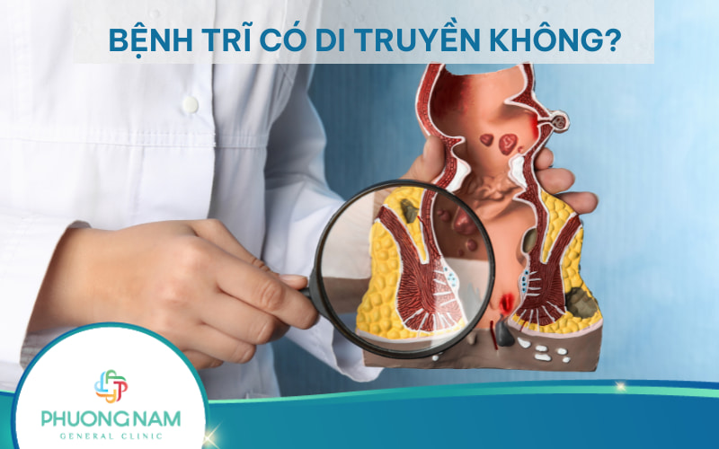 Bệnh trĩ có di truyền không? Các yếu tố gây nên bệnh trĩ là gì?