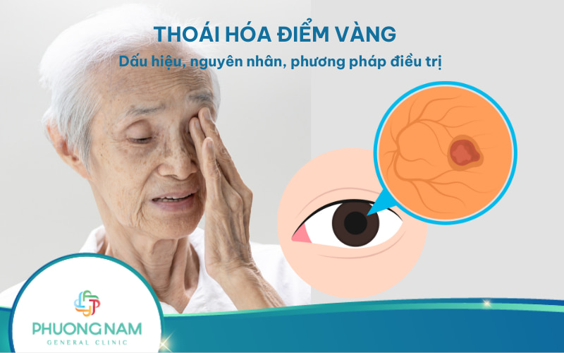 Thoái hóa điểm vàng: Nguyên nhân, phân loại và cách phòng ngừa