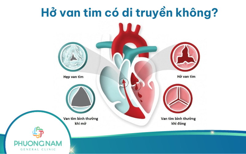 Hở van tim có di truyền không? Phòng ngừa hở van tim như thế nào?