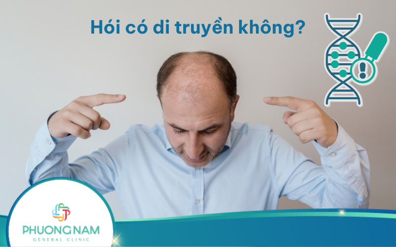 Hói có di truyền không? Và các yếu tố gây tình trạng hói!