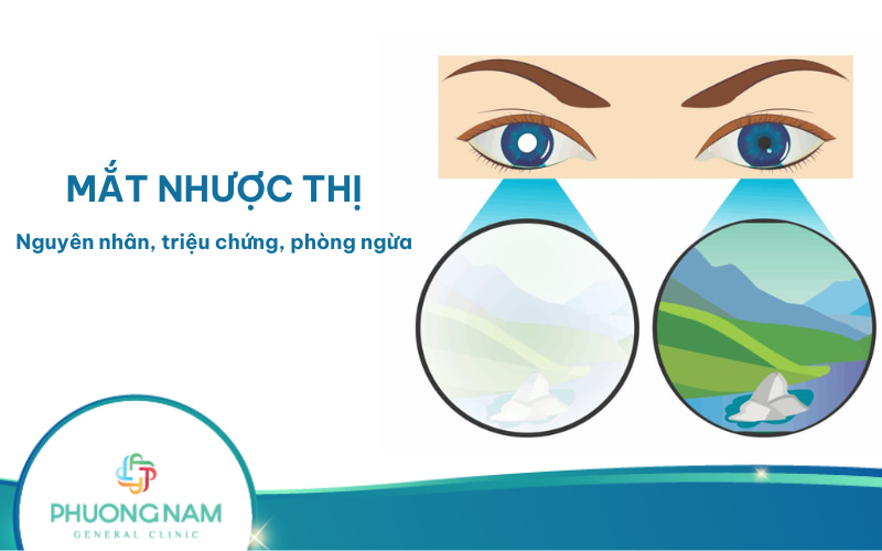 Mắt nhược thị (Mắt lười): Nguyên nhân, triệu chứng và cách điều trị
