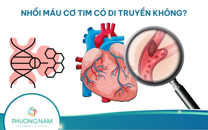 Nhồi máu cơ tim có di truyền không? Nguyên nhân & cách phòng bệnh!