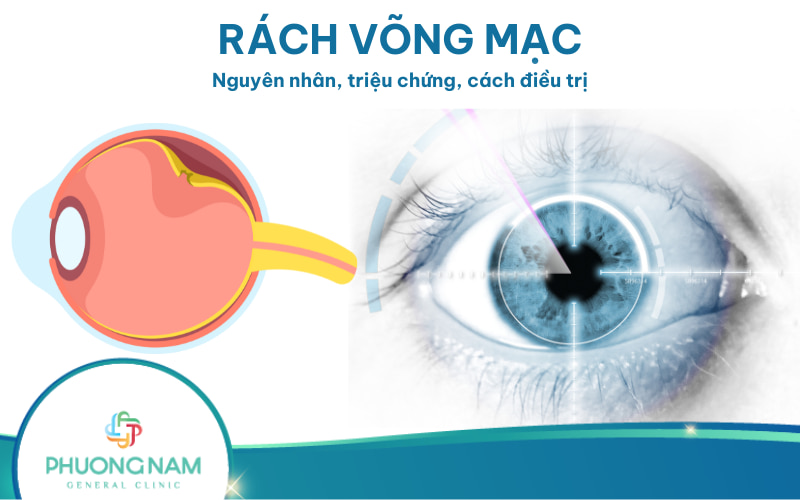 Bong võng mạc: Nguyên nhân, triệu chứng và cách điều trị