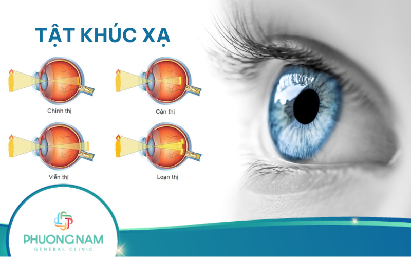 Tật khúc xạ: Nguyên nhân, dấu hiệu, chẩn đoán và phòng ngừa