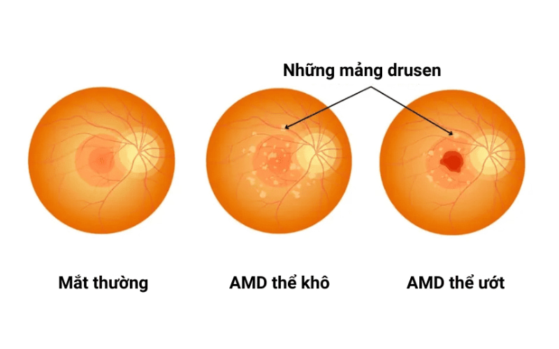 Thoái hóa điểm vàng có hai dạng chính là thể khô và thể ướt.