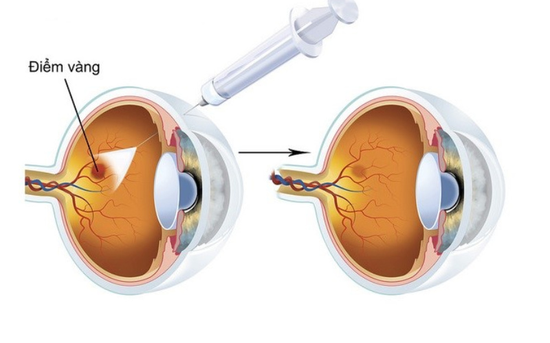 Với thoái hóa điểm vàng thể khô, hiện chưa có phương pháp điều trị khỏi hoàn toàn. 