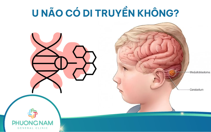 U não có di truyền không? Nguyên nhân & cách phòng ngừa bệnh!