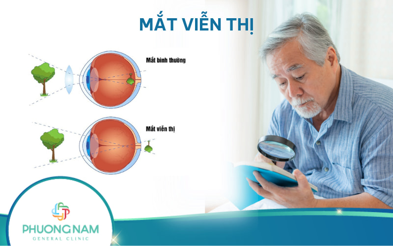 Viễn thị: Nguyên nhân, triệu chứng và các điều trị