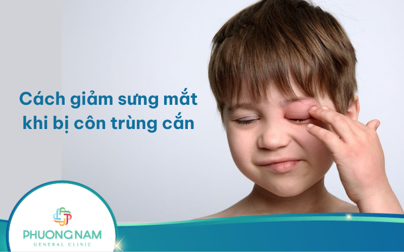 Cách giảm sưng mắt khi bị côn trùng cắn hiệu quả