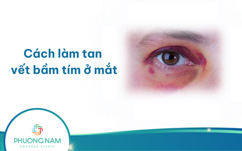 Cách làm tan vết bầm tím ở mắt nhanh chóng, hiệu quả