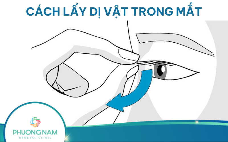 Cách lấy dị vật trong mắt an toàn, nhẹ nhàng