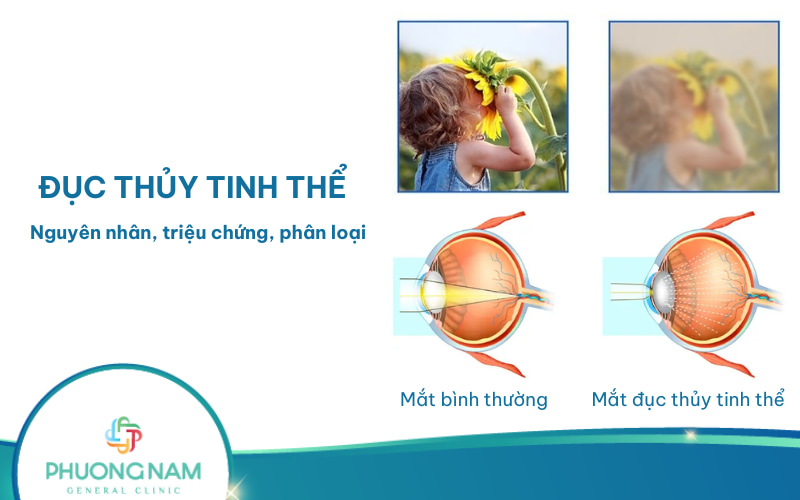Đục thủy tinh thể: Nguyên nhân, triệu chứng và điều trị