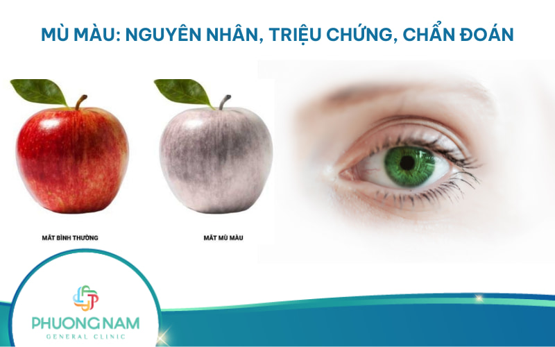 Mù màu: Nguyên nhân, triệu chứng và cách điều trị