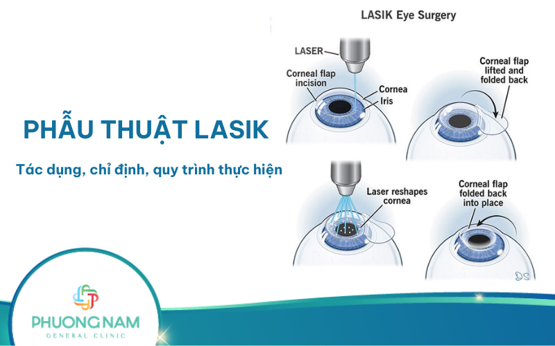Phẫu thuật Lasik là gì? Tác dụng, chỉ định, quy trình thực hiện